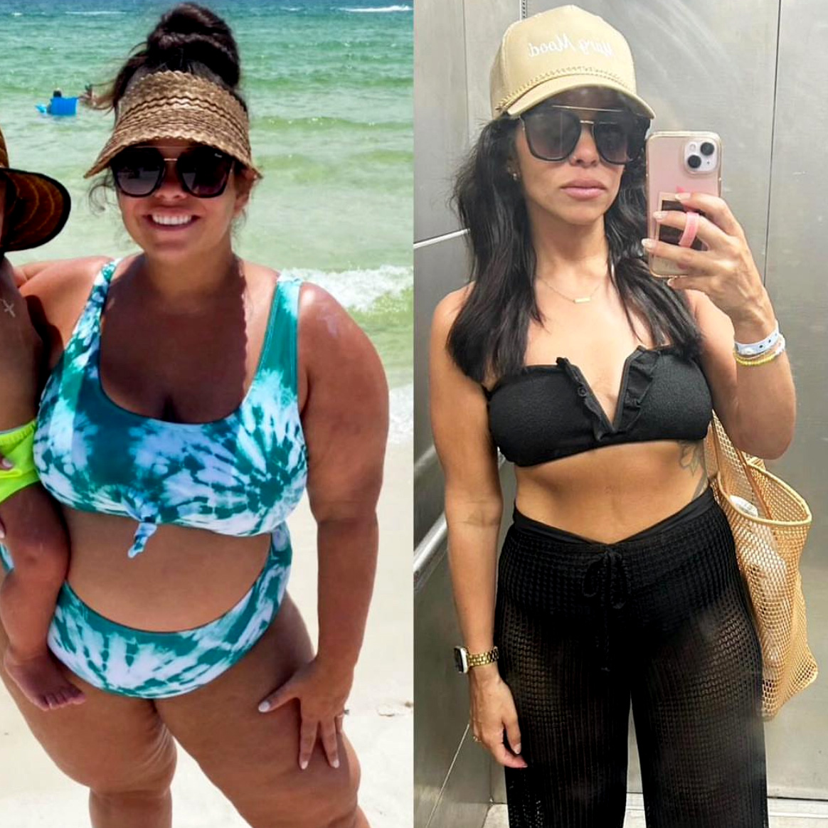 Bariatric Surgeries after photo